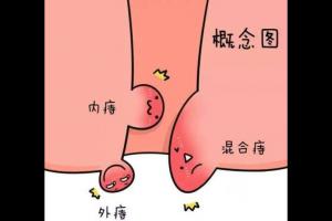 内痔是什么？长内痔的原因以及如何预防内痔生成