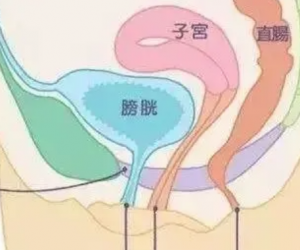 女人跑步跳绳漏尿怎么办，女人跑步跳绳漏尿应做什么运动