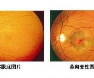 眼底黄斑是怎么回事，如何治疗眼底黄斑