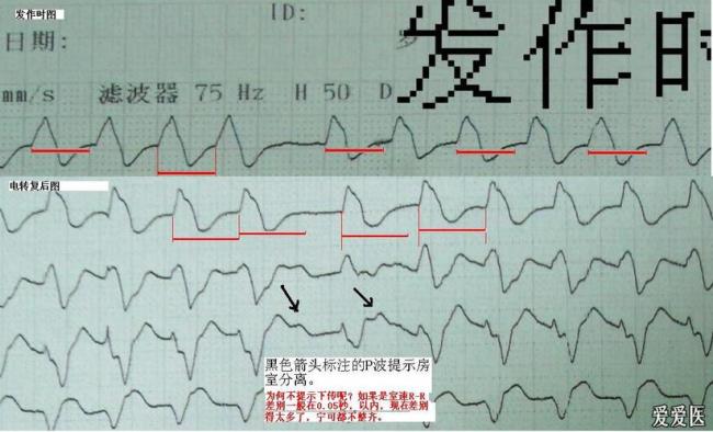 突然心动过速是怎么回事