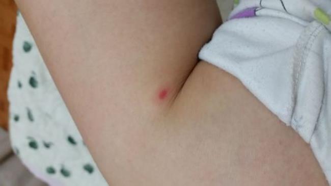 大腿起红点不疼不痒是什么原因