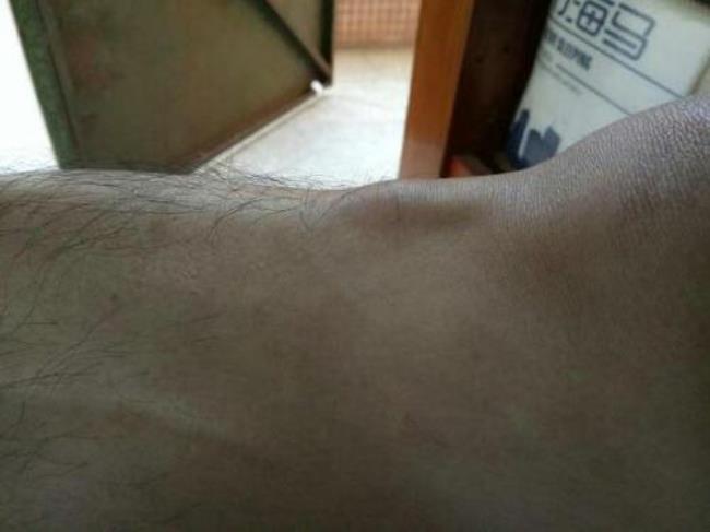 膝盖起了个包不痛不痒软软的