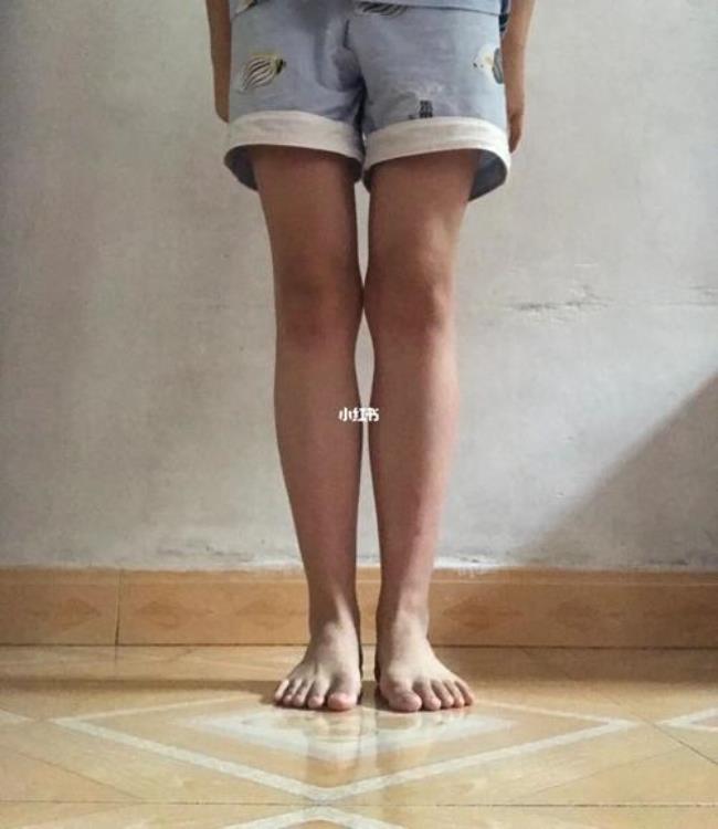 怪腿是什么腿