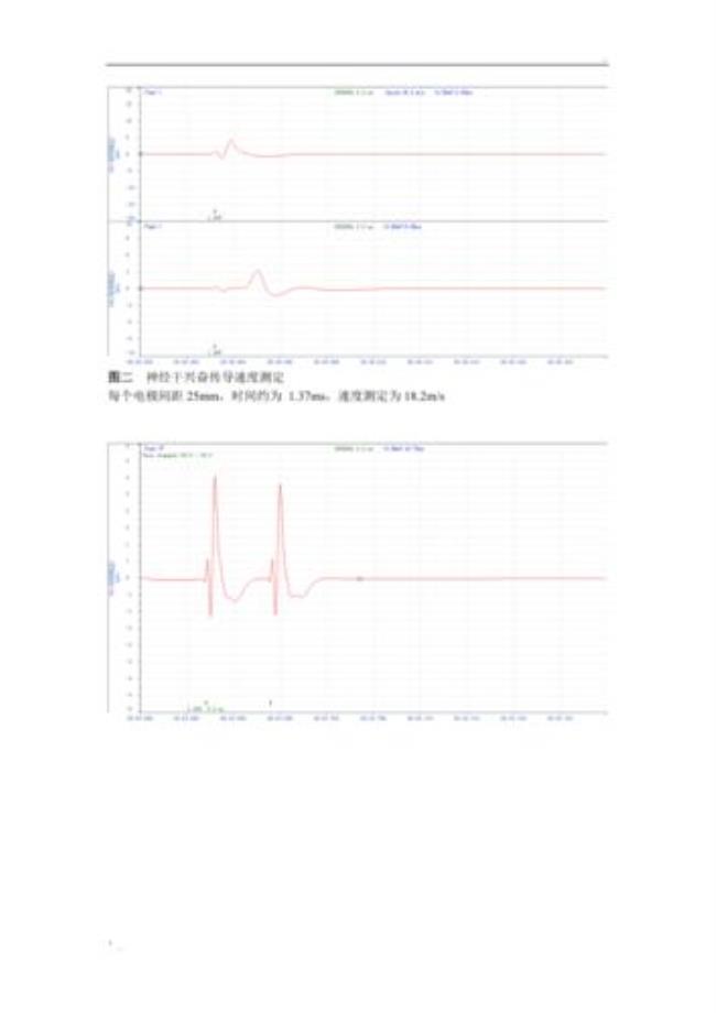 神经纤维动作电位什么意思