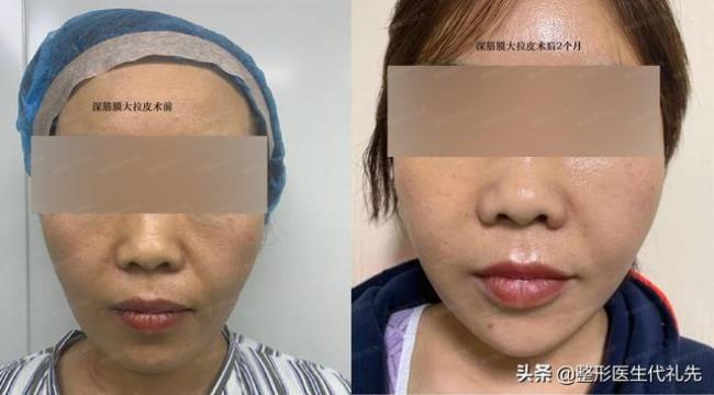 腹部拉皮整形的手术方法是什么