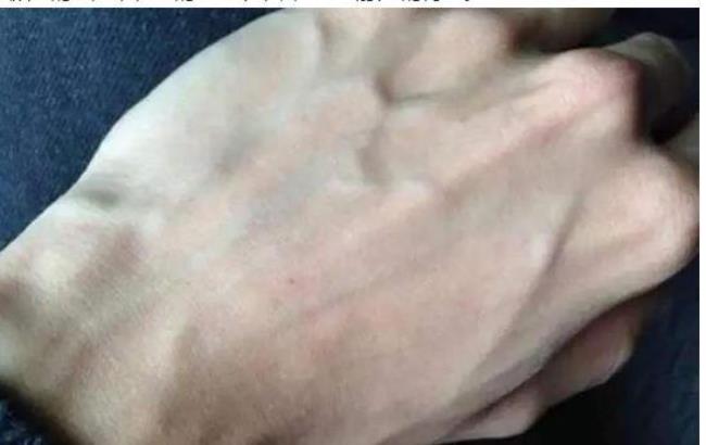 手上青筋暴起是怎么回事