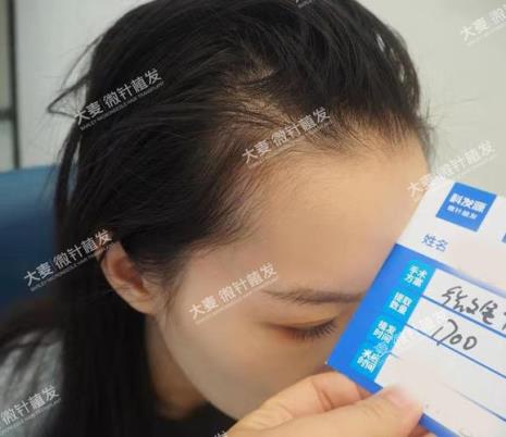 植发师要什么证