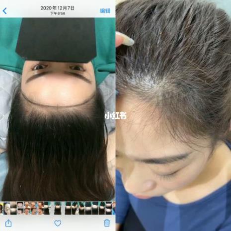 发际线测试软件