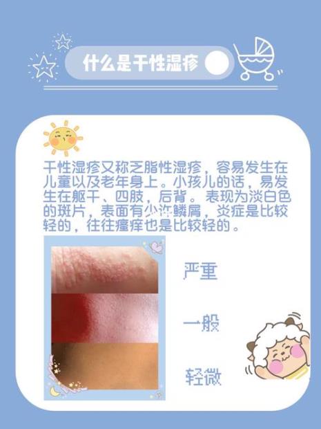 婴儿干性湿疹