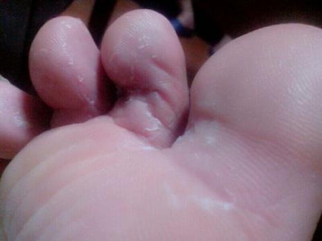 溃烂的脚用什么清理