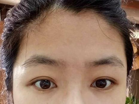 4指半的发际线算正常