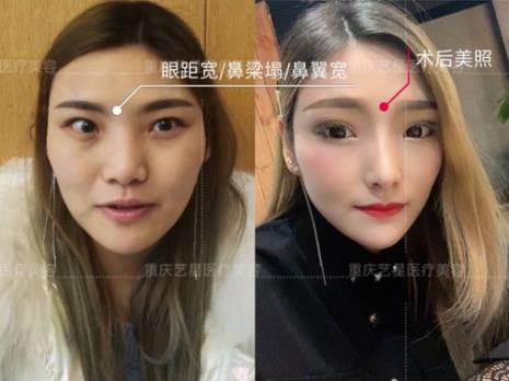 眼距宽拍照注意什么