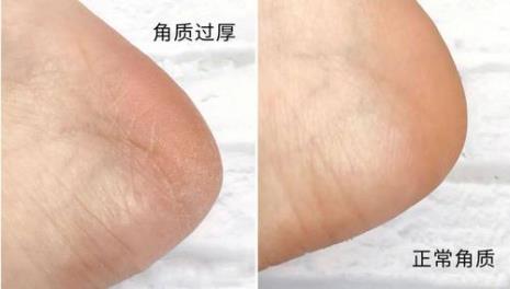 为什么手比脚更嫩
