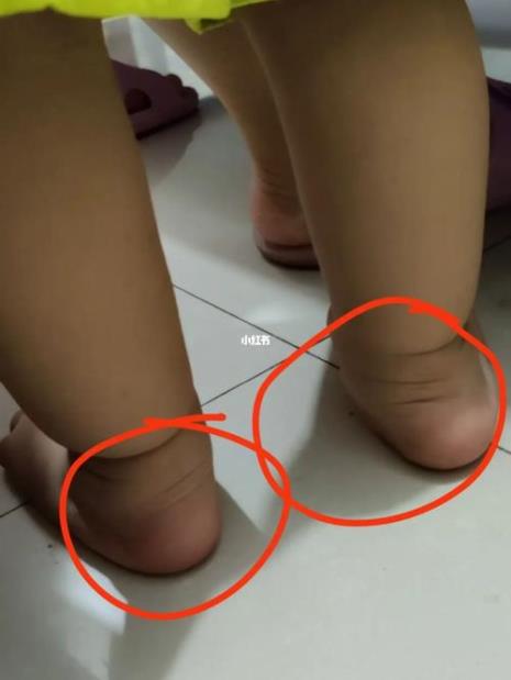 儿童足外翻有什么危害