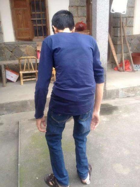 强制性脊柱炎怎么办