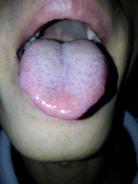 舌头咬破了一直流血怎么办