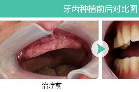 老人全口种植牙价格