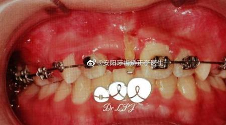 埋伏牙属于保险报销范围吗