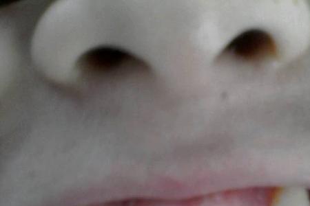 掉了颗门牙补上一颗要多少钱