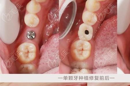 堵一颗牙要多少钱