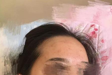 脸上有痘痘可以打水光针吗