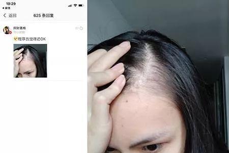 发际线高叫做秃什么