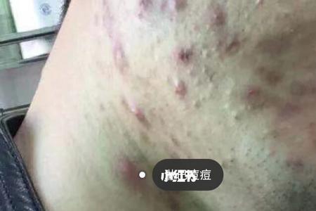 长痘痘的男生留什么发型好