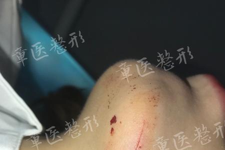 皮肤粘合剂和缝线哪个效果好