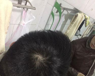 发旋处没头发可以烫羊毛烫吗