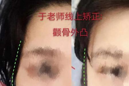 如何判断颧骨是否外扩
