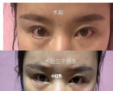 卧蚕一边大一边小怎么办