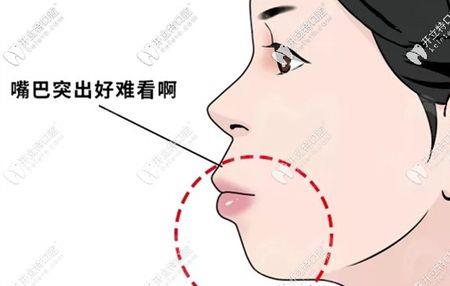 嘴凸多少岁定型