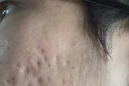 脸上坑坑洼洼有油用什么洗面奶