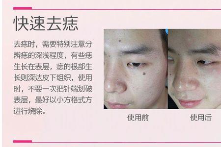 美容点痣扫斑笔使用方法