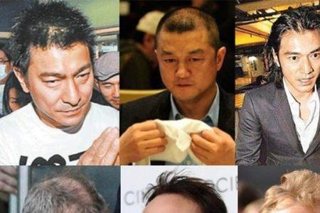 30岁秃头的男人多吗