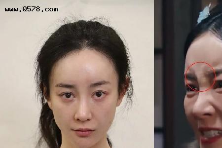 整容脸与正常脸的区别
