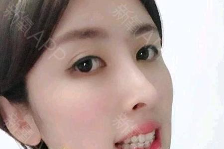 箍牙保持器戴多久