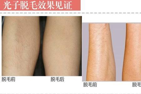 mlayt4脱毛仪效果怎么样