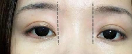 两眼距离太远如何修饰
