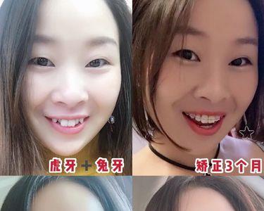 什么样的虎牙才是真的虎牙