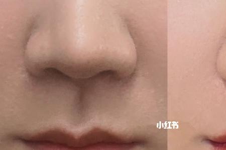 玻尿酸嘴唇适合哪种唇型