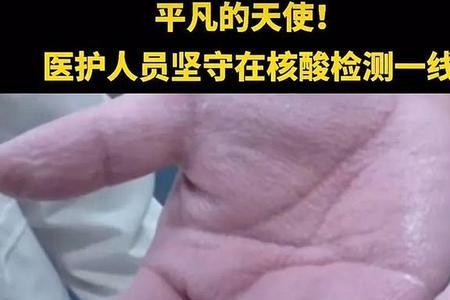 手汗多的人可以当护士吗