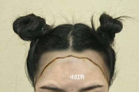 婴儿发际线低好还是不好