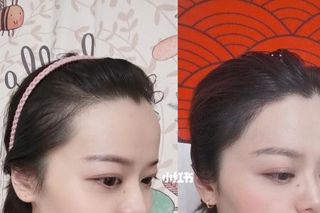 脖子发际线不整齐怎么办