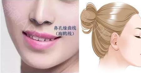 海鸥线过长怎么办