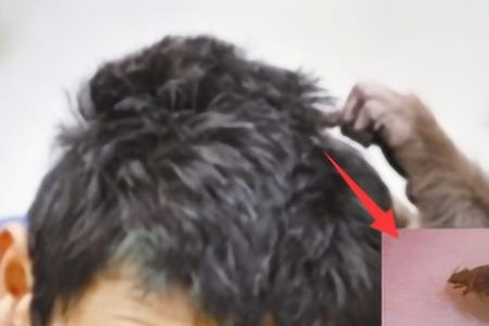 人类头上的虱子长什么样子