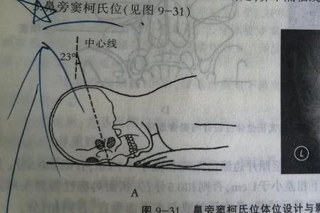 听眶线与听眦线区别图