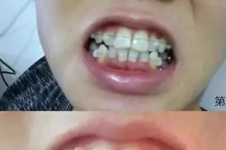 箍牙钢丝是进口还是国产的好