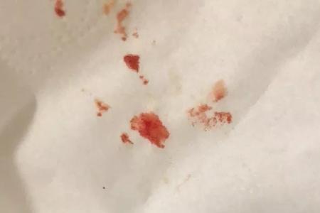 后槽牙卡了东西挑不出来