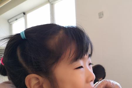 儿童几岁可以涂氟
